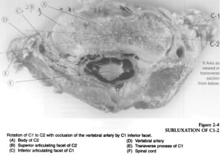 Figure 3: C1-C2 SUBLUXATION and OCCLUSION of VERTEBRAL ARTERY